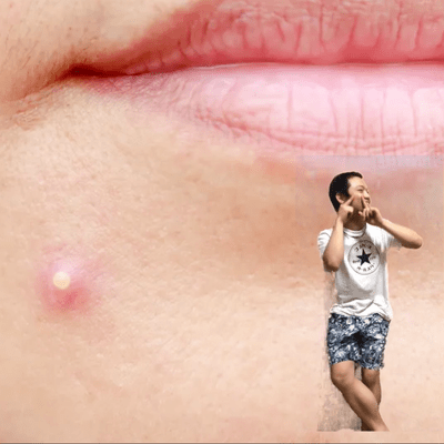 Pimple Song Front Cover
